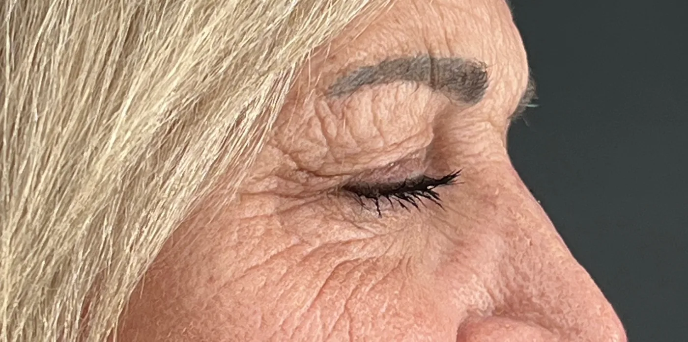Tixel before treatment