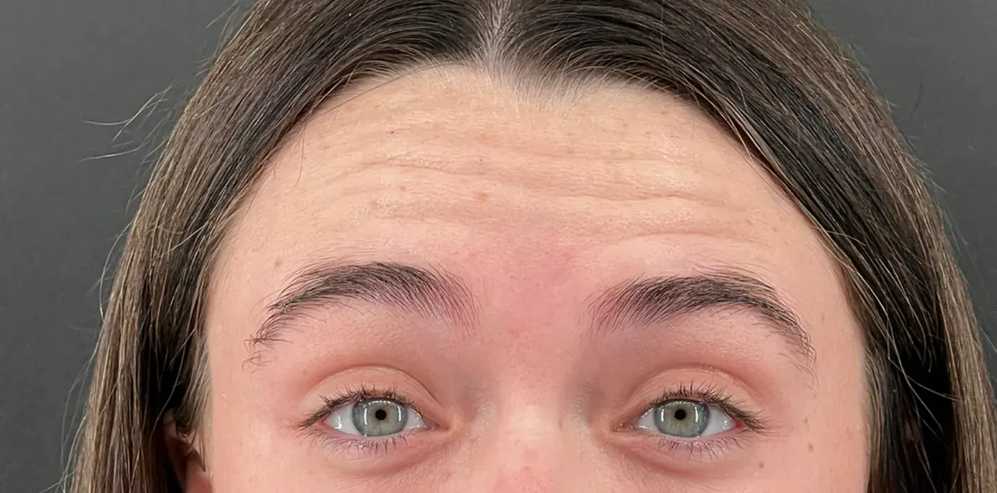 Neurotoxin before treatment
