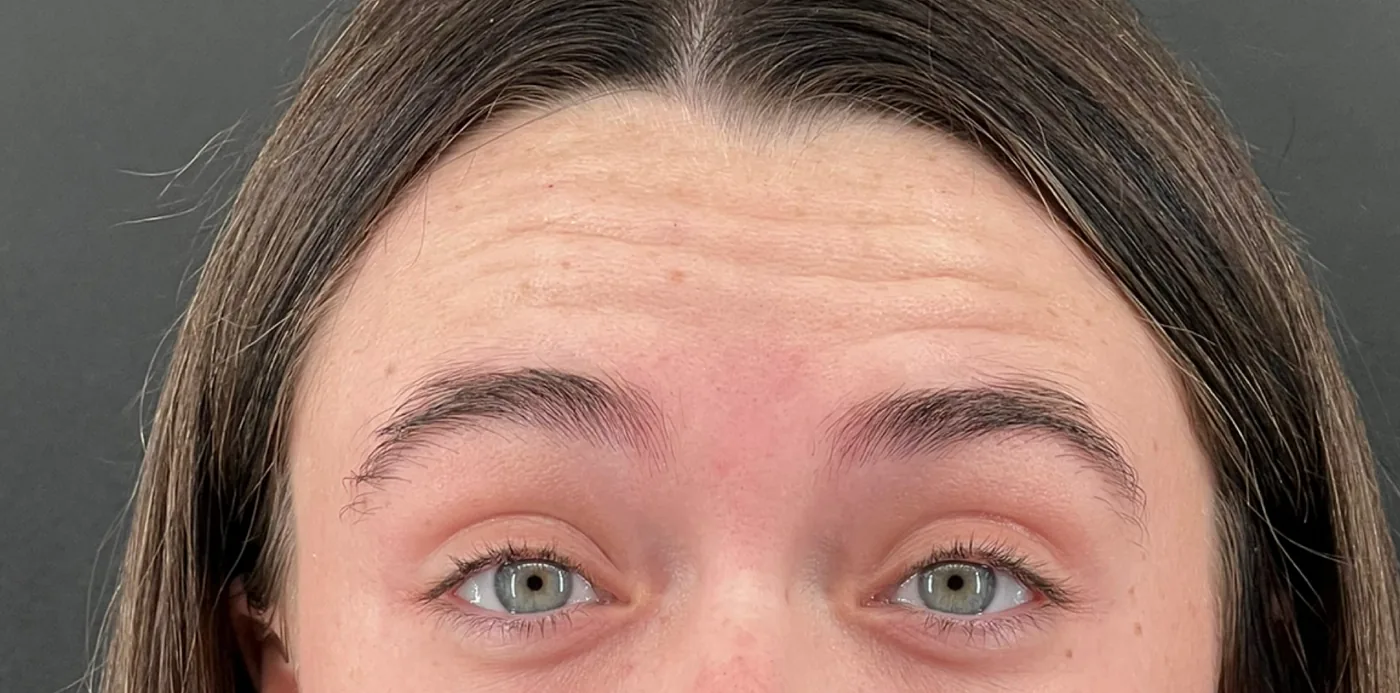 Neurotoxin before treatment