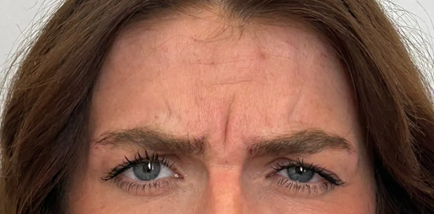 Neurotoxin before treatment