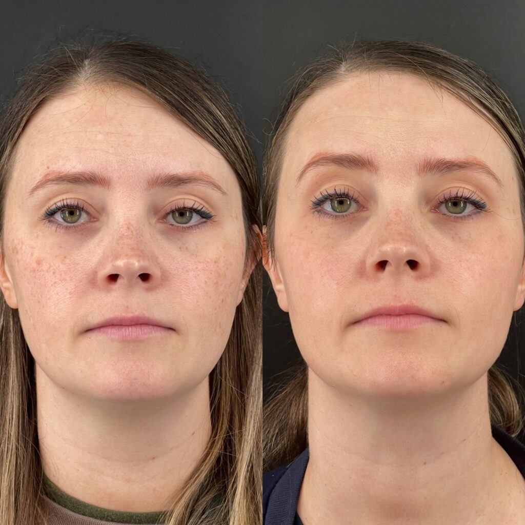 IPL Photofacials in Oklahoma City, OK